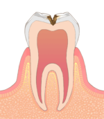 象牙質まで進んだむし歯の症状